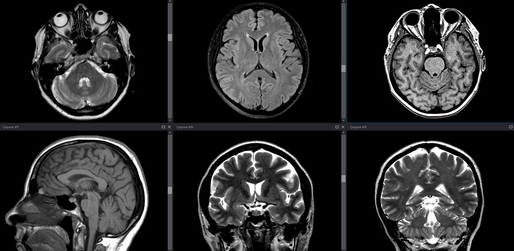 МРТ головного мозга